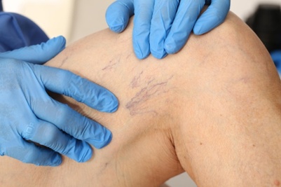 The Benefits of Sclerotherapy for Treating Spider Veins