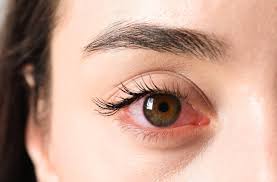 Understanding Common Triggers for Red Eyes in Everyday Life